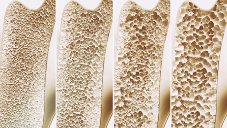 Verlauf bei Osteoporose